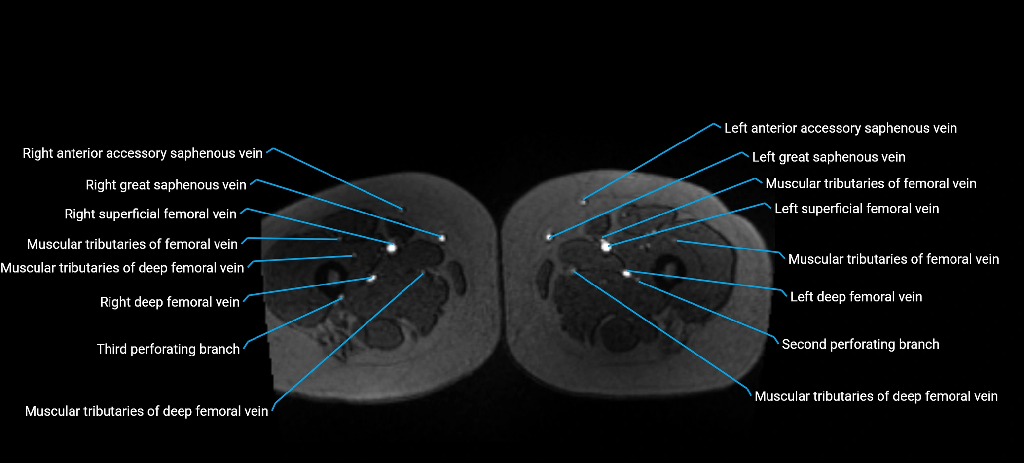 MRV abdomen pelvis & lower limb axial cross sectional anatomy labelled MRI image 242 (1).webp